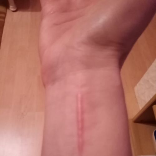 © Echte Narbe rechter Innenarm (geg für Unfallszenen)